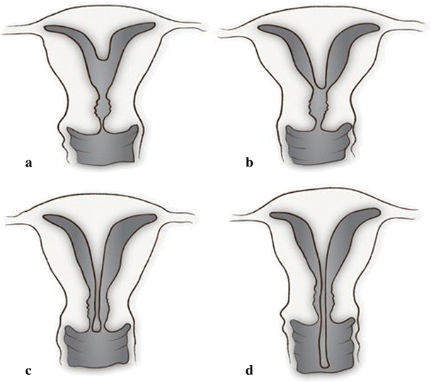 Septate uterus: nosographic overview and endoscopic treatment |  Gynecological Surgery | Full Text