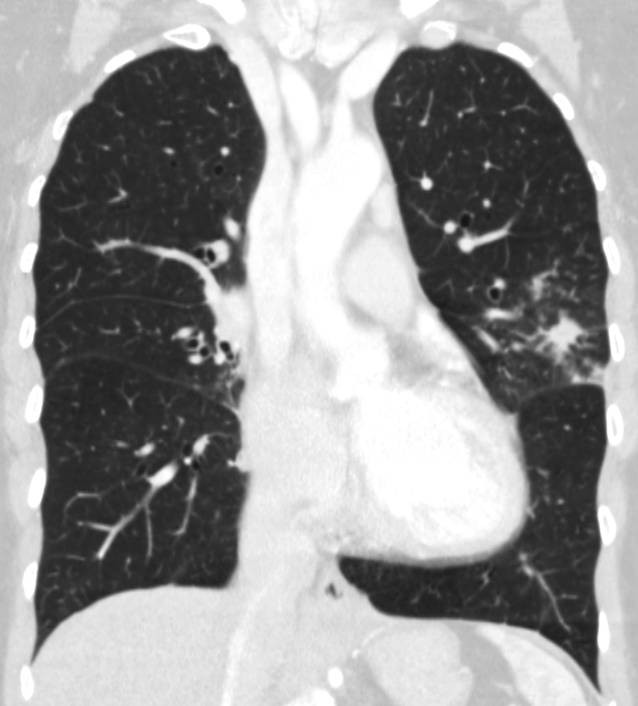 Seltene bakterielle Erkrankungen der Lunge | SpringerLink