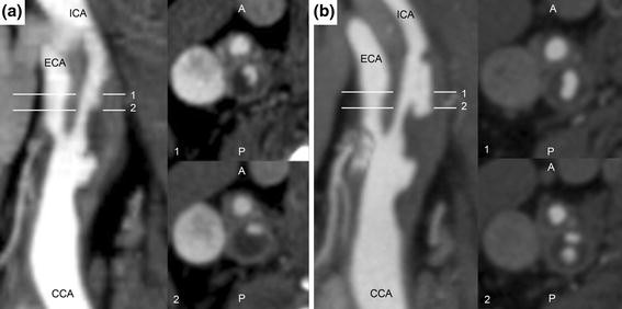 Visual for Carotid Atheroma Rupture Observed In Vivo and FSI-Predicted Stress Distribution Based on Pre-rupture Imaging