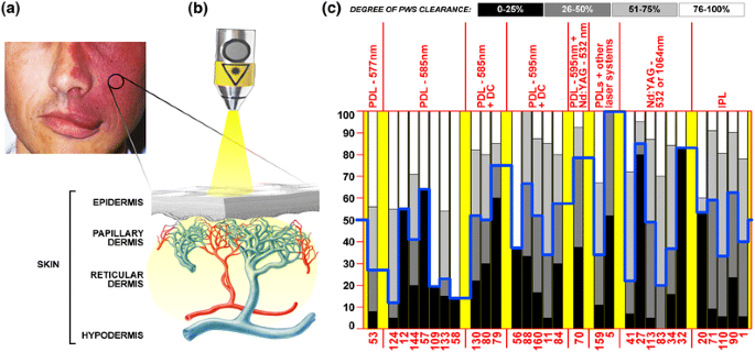 An Overview of Three Promising Mechanical, Optical, and Biochemical  Engineering Approaches to Improve Selective Photothermolysis of Refractory  Port Wine Stains | Annals of Biomedical Engineering