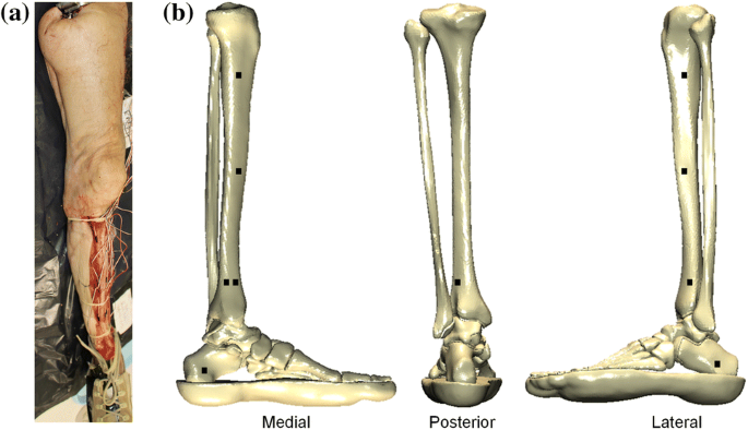 Tibial Pursuit: How to identify and side the tibia