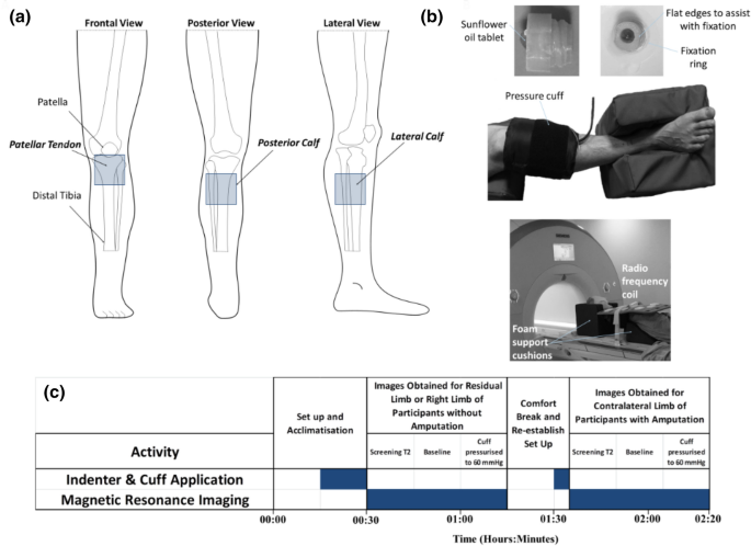 Changes in Tissue Composition and Load Response After Transtibial  Amputation Indicate Biomechanical Adaptation | SpringerLink