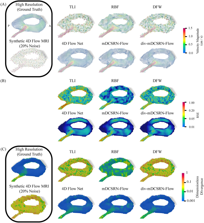 Super-Resolving and Denoising 4D flow MRI of Neurofluids Using Physics ...