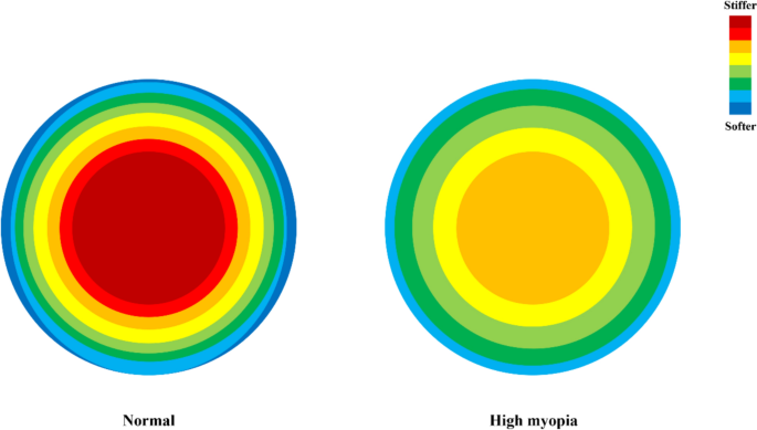 Molecular and Biomechanical Changes in the Anterior Segment of High ...