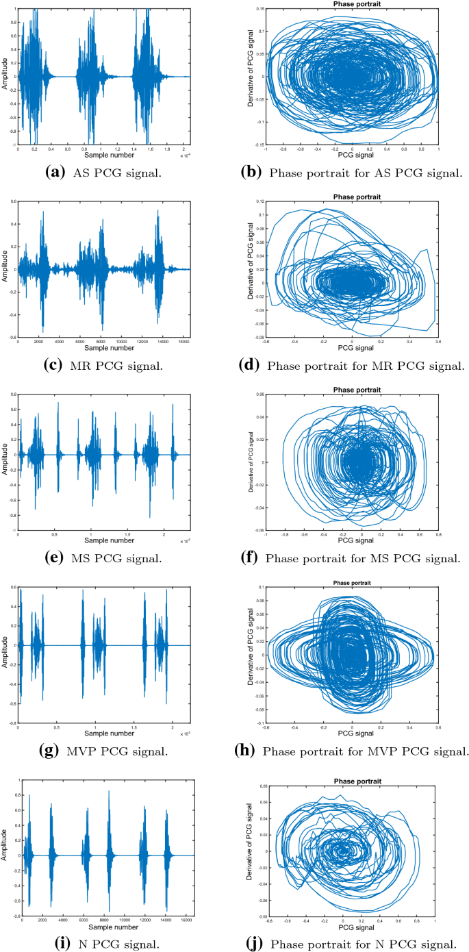 Detection Of Heart Valve Disorders From Pcg Signals Using Tqwt Fa Mvemd Shannon Energy Envelope And Deterministic Learning Springerlink