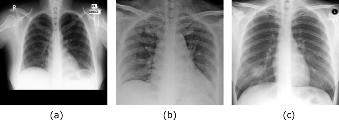 Classification Of Covid 19 In Chest X Ray Images Using Detrac Deep Convolutional Neural Network Springerlink