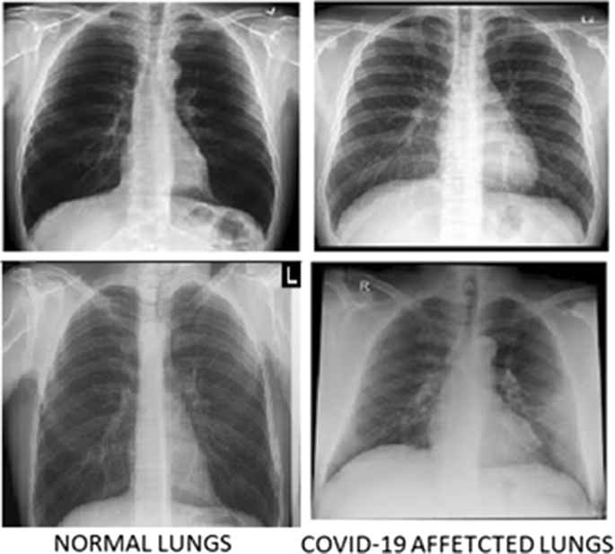 Detection Of Covid 19 Using Cxr And Ct Images Using Transfer Learning And Haralick Features Springerlink