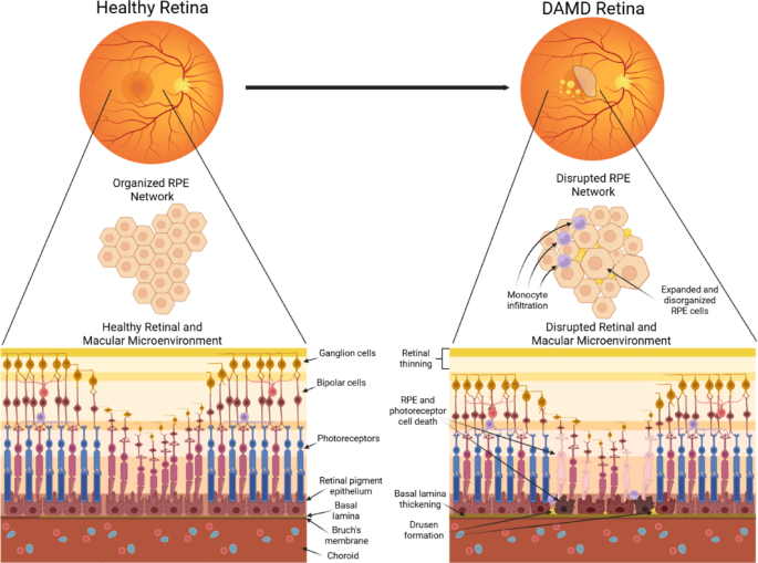 acetyl-l-carnitine and macular degeneration The intersection of mitochondria, lipids, and ferroptosis: a new avenue for  dry age-related macular degeneration | Apoptosis