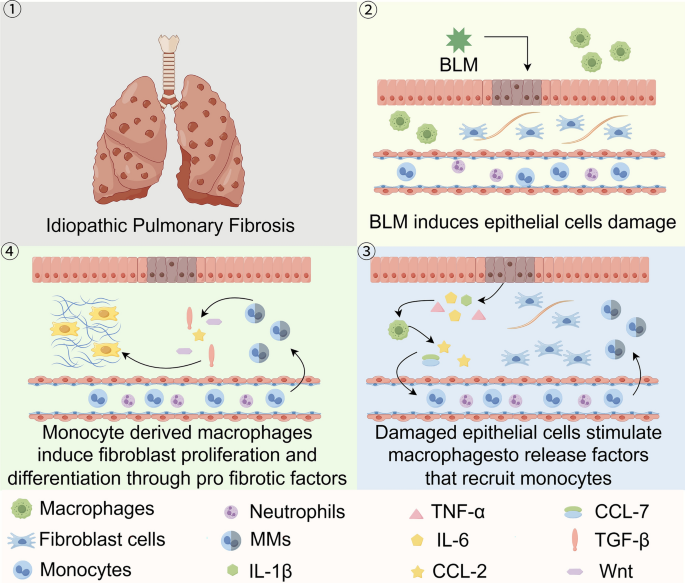 Monocyte-mediated mechanisms in idiopathic pulmonary fibrosis ...