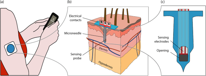 Real Time Intradermal Continuous Glucose Monitoring Using A Minimally Invasive Microneedle Based System Springerlink