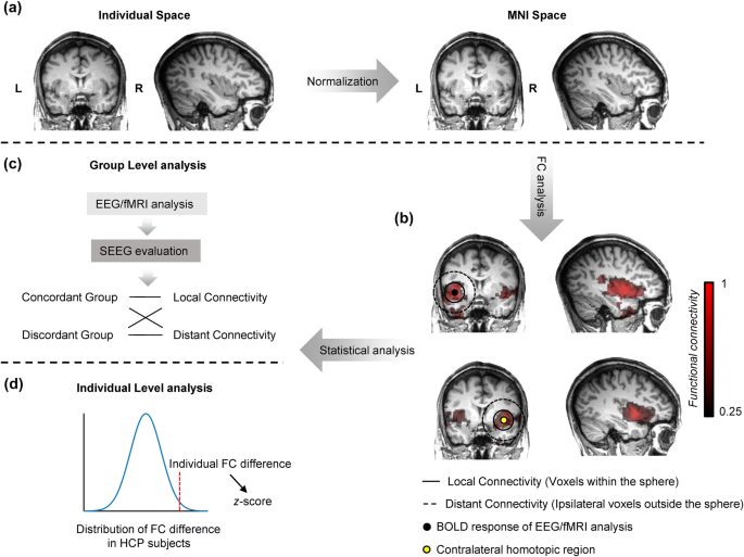 Enhanced Regional Functional Connectivity Indicates Seizure Onset Zone Springerlink Enhanced Regional Functional Connectivity Indicates Seizure Onset Zone Springerlink