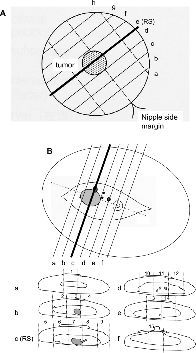 Comparison of proportions and prognostic impact of pathological ...