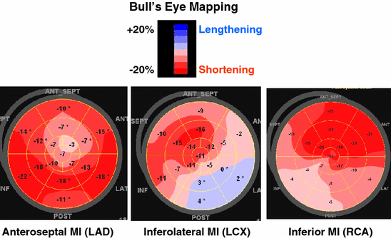 Longitudinal strain bull's eye plot patterns in patients with  cardiomyopathy and concentric left ventricular hypertrophy, European  Journal of Medical Research