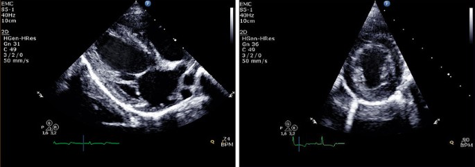 Speckle tracking echocardiography in hypokinetic non‐dilated  cardiomyopathy: comparison with dilated cardiomyopathy - Mombeini - 2020 -  ESC Heart Failure - Wiley Online Library