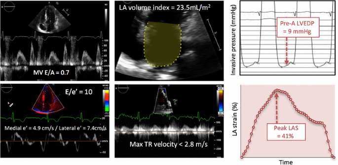 Non‐invasive assessment of left ventricular filling pressure - Nagueh -  2018 - European Journal of Heart Failure - Wiley Online Library