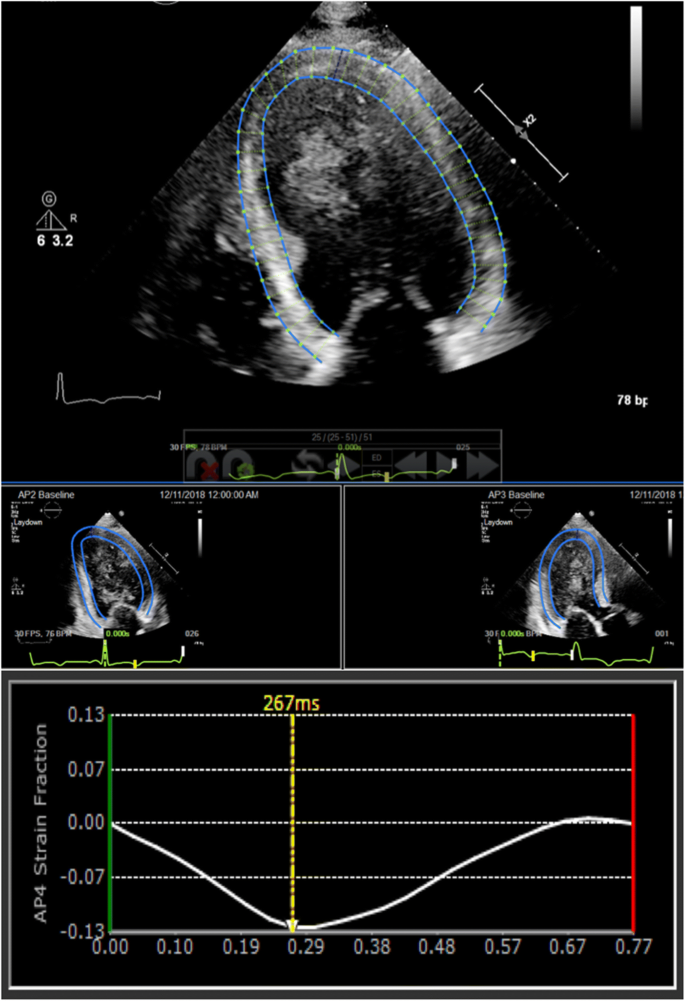 Journal of Cardiovascular Computed Tomography - Agreement is strong between  4D CCT and speckle tracking echocardiography only for LV global  longitudinal strain. Other features demonstrated mod or weak correlation.  #yesCCT