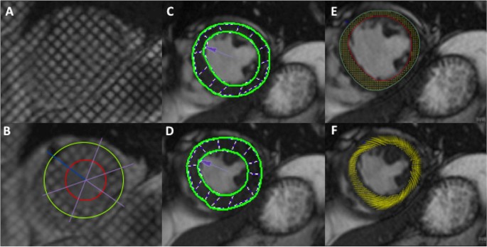 Inter Study Repeatability Of Circumferential Strain And Diastolic Strain Rate By Cmr Tagging Feature Tracking And Tissue Tracking In St Segment Elevation Myocardial Infarction Springerlink