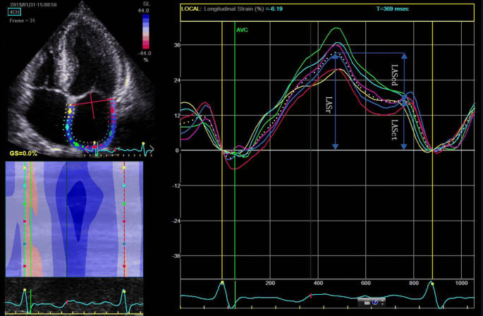Left Atrial Strain in the Analysis of LV Diastolic Function: Ready to Use?  - ABC Imaging