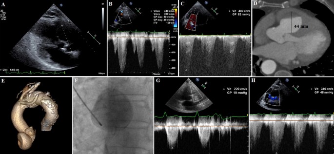 Giant Sinus Of Valsalva Aneurysm Mimicking Severe Pulmonary Hypertension Springerlink