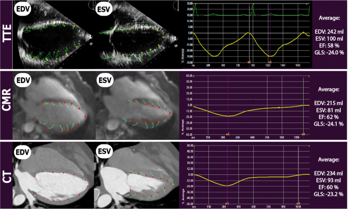 Advances in echocardiography: global longitudinal strain, intra-cardiac  multidirectional flow imaging and automated 3d volume analysis