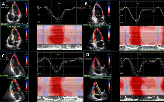 Speckle Tracking Echocardiography - an overview