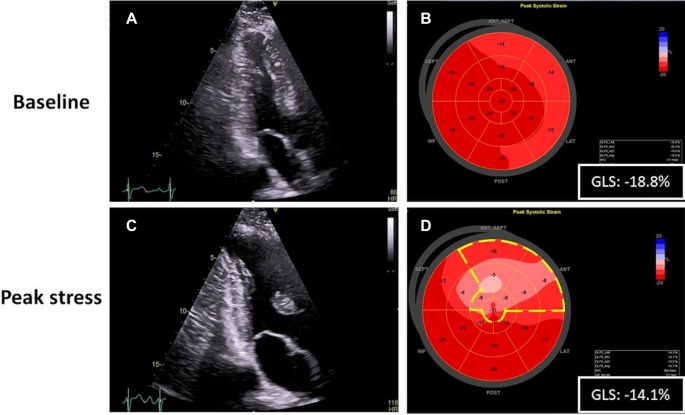Persistence of abnormal global longitudinal strain in women with peripartum  cardiomyopathy - Bortnick - 2021 - Echocardiography - Wiley Online Library