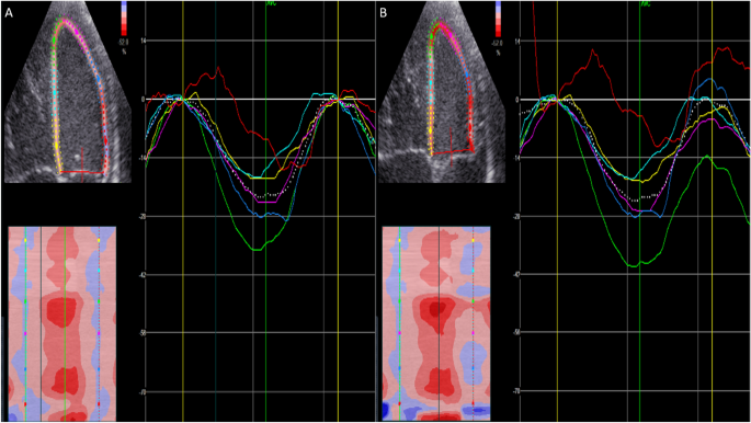 Speckle tracking derived strain in neonates: planes, layers and drift