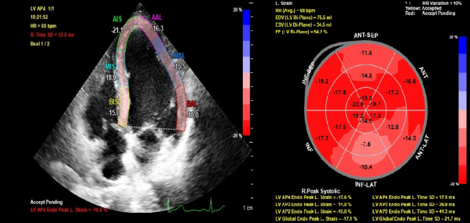 Evaluation of left ventricular global functions with speckle tracking  echocardiography in patients recovered from COVID-19