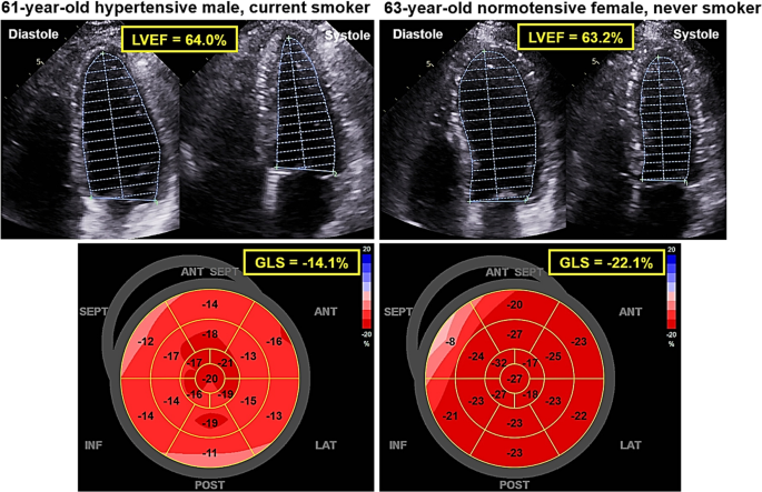 JACC Journals - Journals of the American College of Cardiology - Editors'  Insights: Global longitudinal strain on echo is complementary to left  ventricular ejection fraction, with additive value in many cardiovascular  diseases