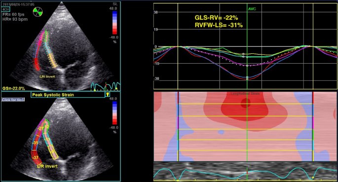 SPECKLE TRACKING RV GLOBAL LONGITUDINAL STRAIN FOR PREDICTION OF PULMONARY  HYPERTENSION - Canadian Journal of Cardiology