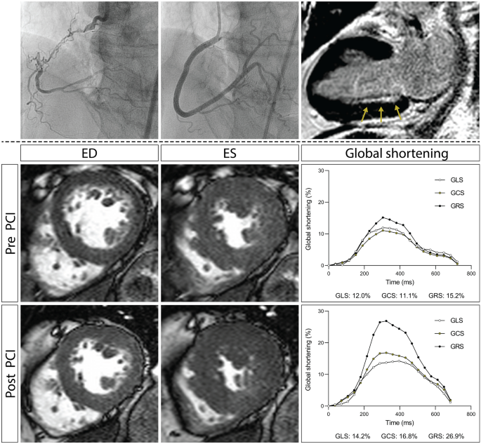 Improvement of left ventricular function assessment by global longitudinal  strain after successful percutaneous coronary intervention for chronic  total occlusion
