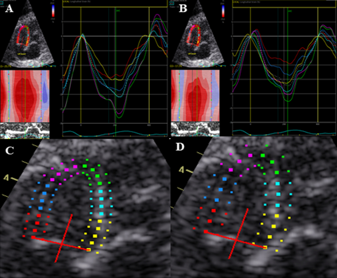 Strain Echocardiography by speckle tracking and tissue Doppler -Part  I:technique 