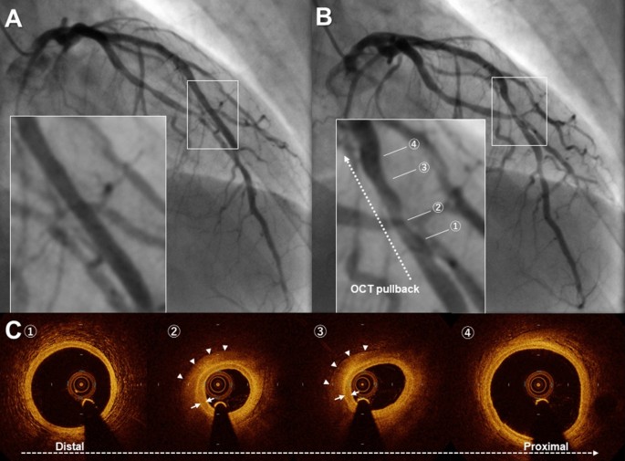 Update on Myocardial Bridging