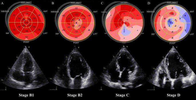 Left Ventricular Global Longitudinal Strain as a Predictor for