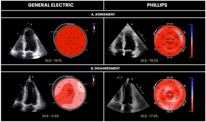 A global longitudinal strain cut‐off value to predict adverse