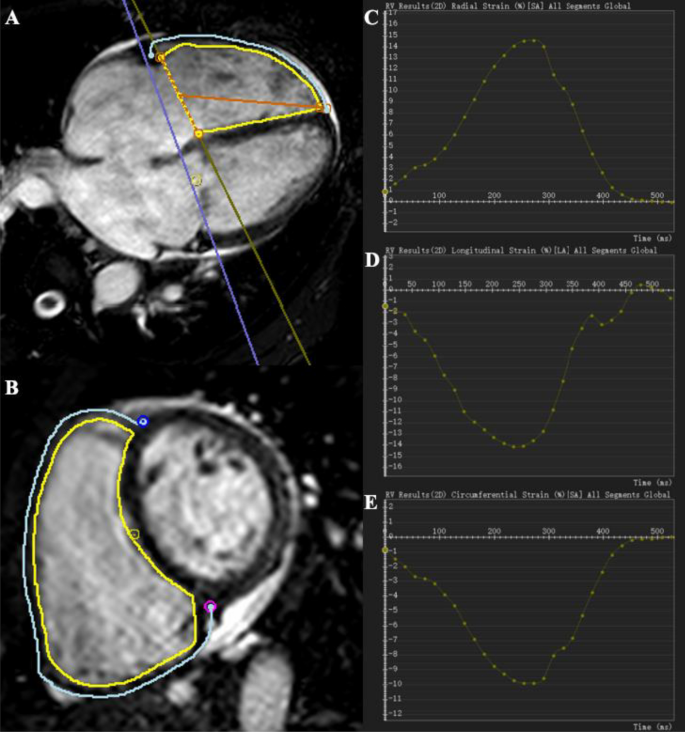 Myocardial strain assessed by feature tracking cardiac magnetic resonance  in patients with a variety of cardiovascular diseases – A comparison with  echocardiography