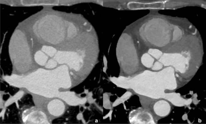ESCR Abstracts 2022 | The International Journal Of Cardiovascular.