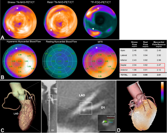 Discordant myocardial perfusion defects and coronary artery disease – a ...