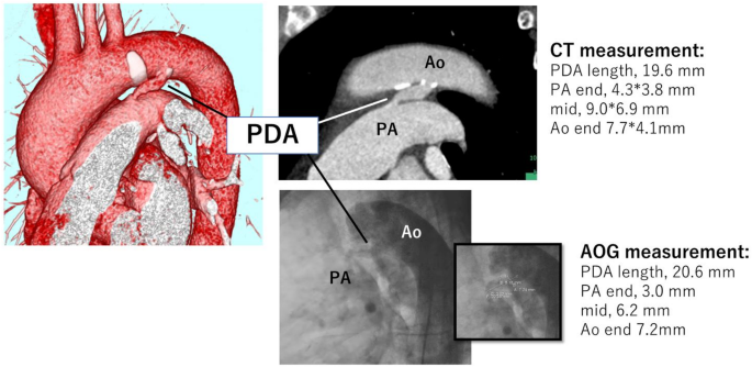 Krichenko Computed tomography versus aortography for transcatheter patent ductus ...