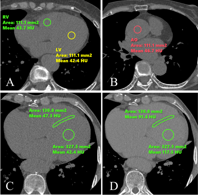 Feasibility of using synthetic myocardial extracellular volume fraction ...