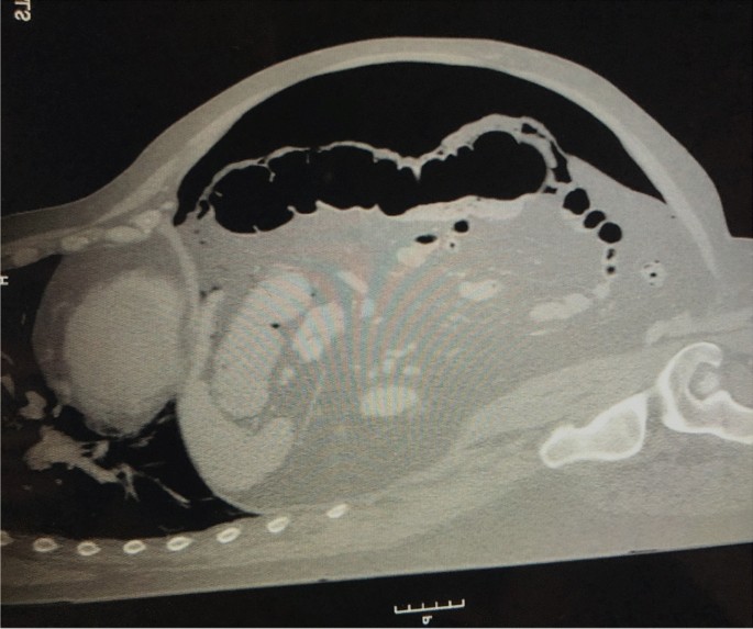 Cec And You Shall Find Cecal Perforation In A Patient With Covid 19 Springerlink