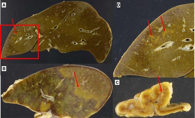 AL Lambda Amyloidosis Activates Acute Liver Failure in the Absence of  Plasma Cell Dyscrasia | SpringerLink