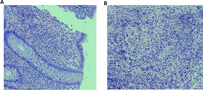 Perianal Fistulizing Crohn’s Disease Combined with Pilonidal Sinus and ...