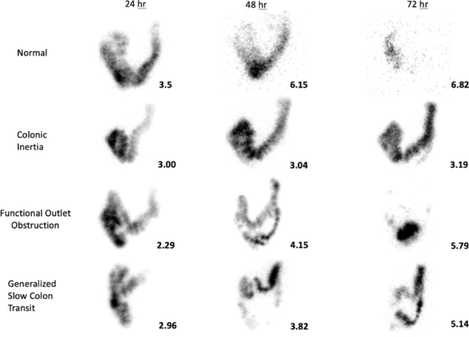 Whole Gut Transit Scintigraphy for the Assessment of Patients with ...