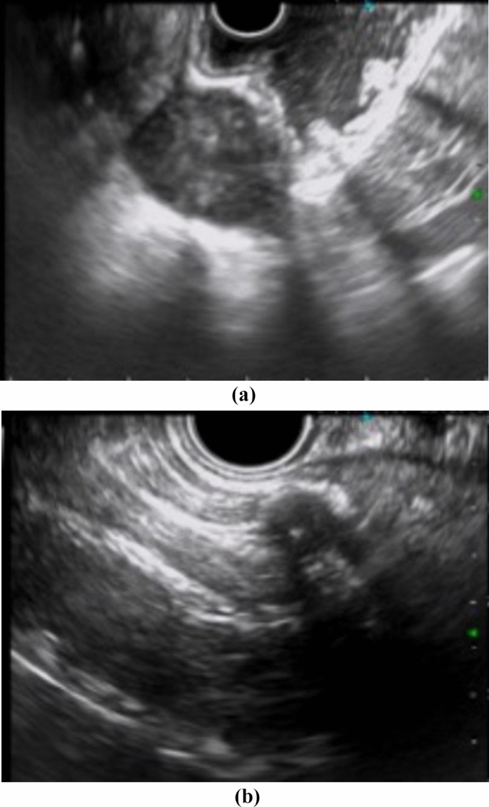 A Case of Multisite Gastric Hepatoid Adenocarcinoma Mimicking Gastric