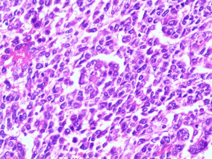 A Case of Multisite Gastric Hepatoid Adenocarcinoma Mimicking Gastric