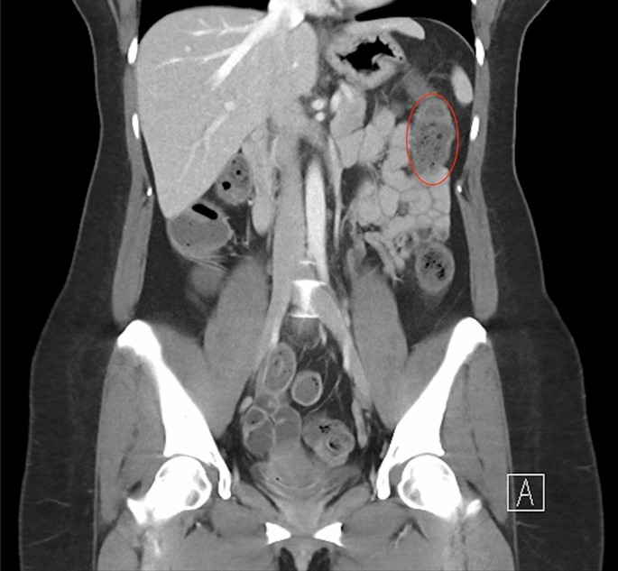 glp 1 rectal bleeding Great Weight, Low Pressure–One Problem: GLP-1 Receptor Agonist-Associated  Colonic Ischemia | Digestive Diseases and Sciences