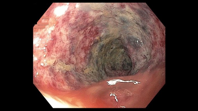 glp-1 colonoscopy Great Weight, Low Pressure–One Problem: GLP-1 Receptor Agonist-Associated  Colonic Ischemia | Digestive Diseases and Sciences