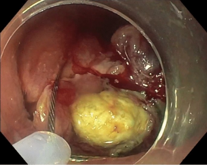 Hidden Fecalith: Uncommon Presentation Within Inflammatory Polyp ...