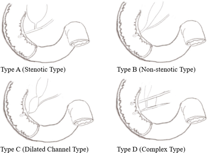 Pancreaticobiliary Maljunction: A Multidimensional Exploration of ...